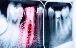 Scientists In Belfast Find That Tooth Decay Can Be Reversed By Aspirin